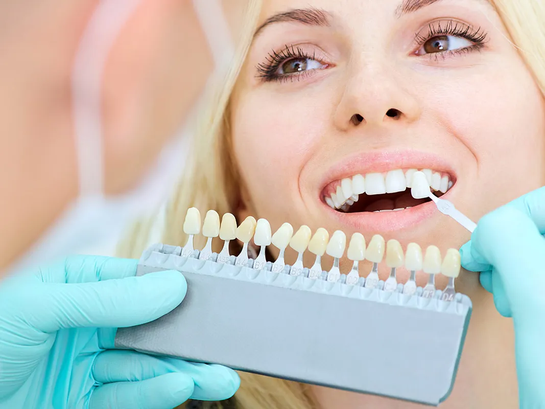 A practitioner holding a tooth shade guide against a client's smile.