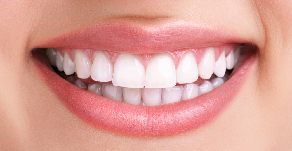 The same teeth after professional whitening, visibly brighter.