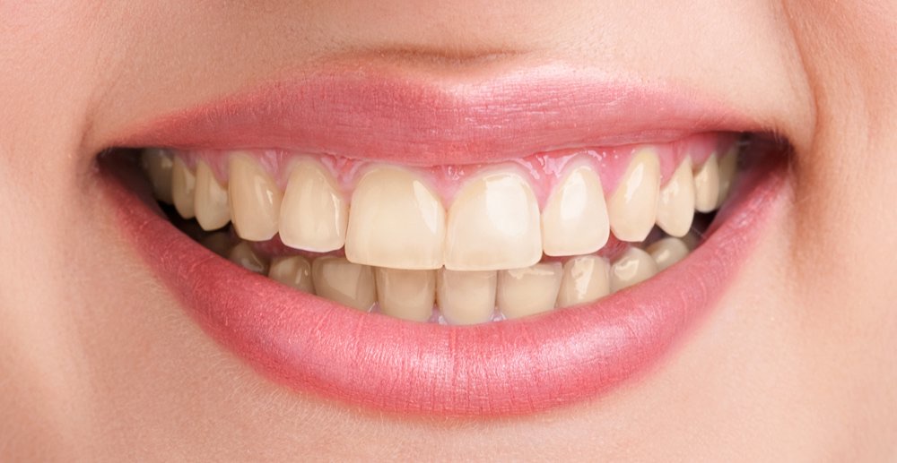 Close-up of teeth before professional whitening, showing yellow discolouration.